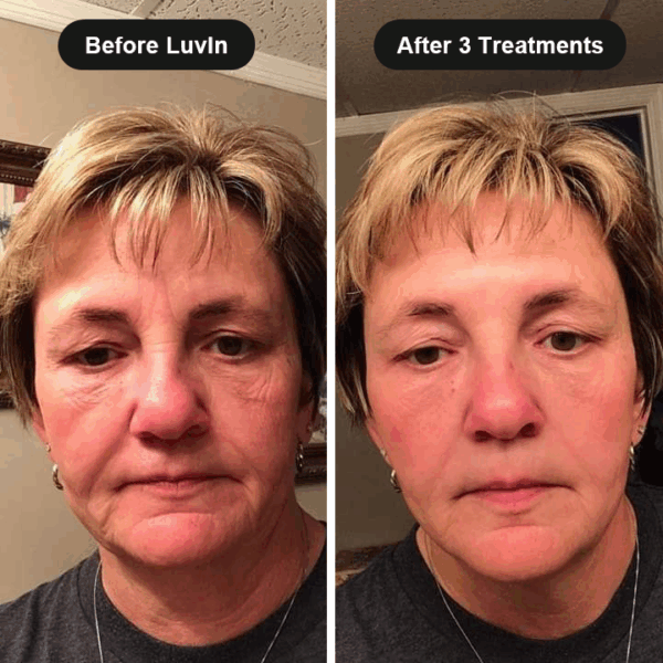 TryLuvin™ Micro Infusion Kit with Peptides - Image 5