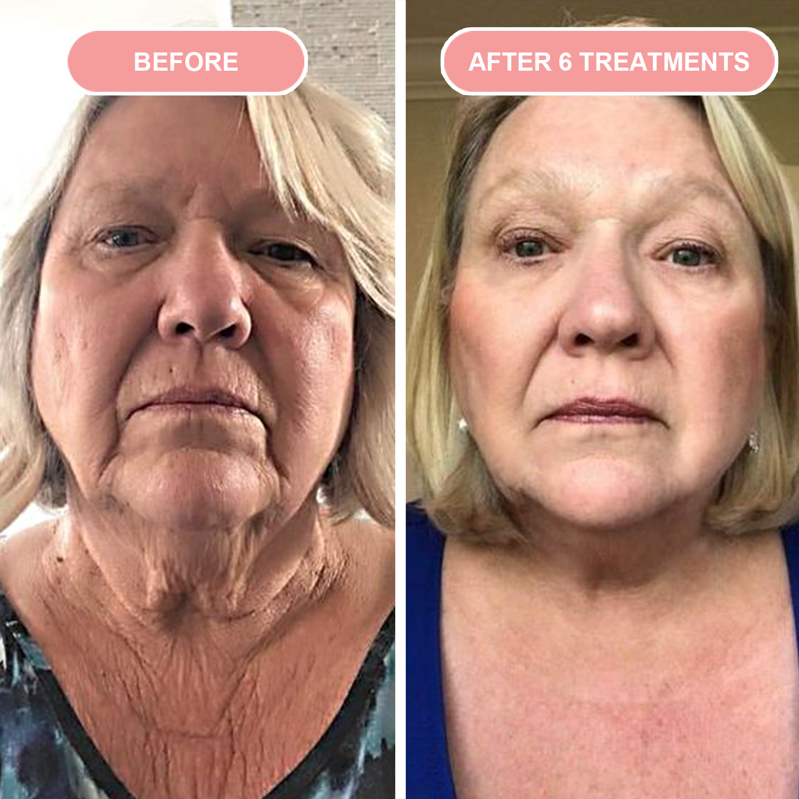 Before & After